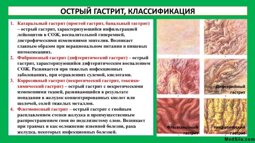 Классификация гастрита